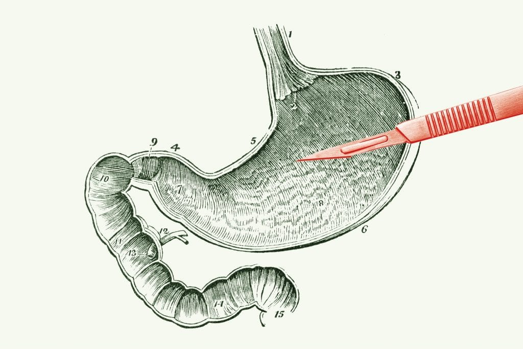 A cirurgia de redução do estômago e a cura do diabetes