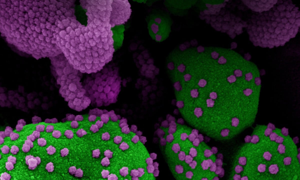 Novo SARS-CoV-2 de Coronavírus; Micrografia eletrônica de varredura colorida de uma célula apoptótica (verde) fortemente infectada com partículas do vírus SARS-COV-2 (roxa), isoladas de uma amostra de paciente. Foto: NIAID/Integrated Research Facility (IRF) 