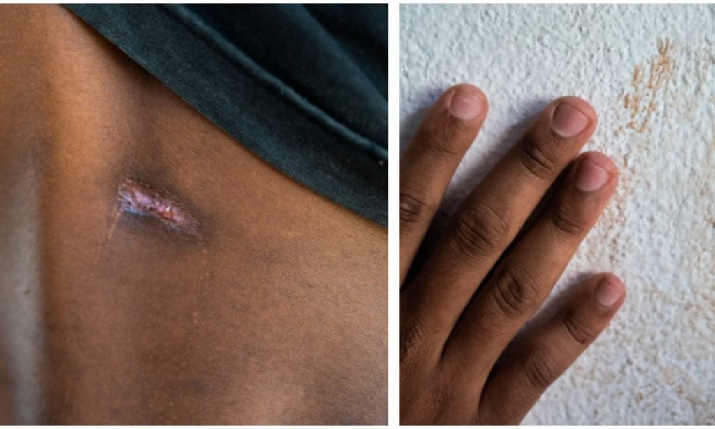 Adolescentes denunciam tortura e mostram marcas de violência em comunidade terapêutica evangélica