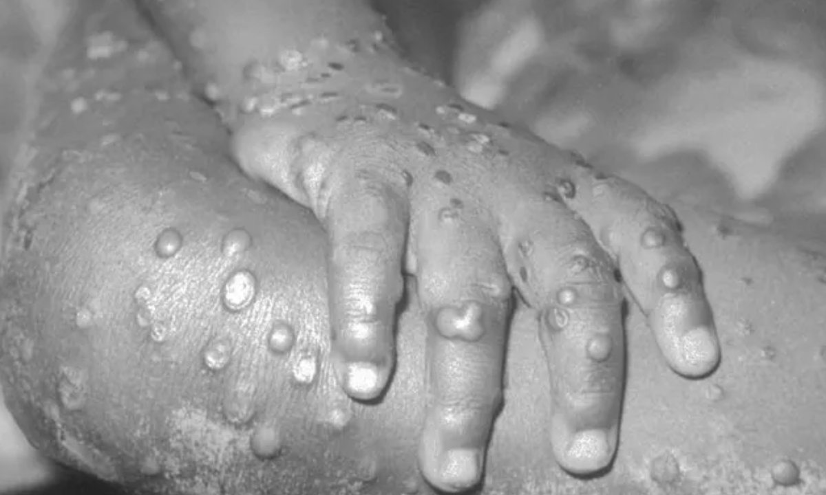 Lesões causadas pela varíola do macaco em uma menina na Libéria — Foto: Wikipedia 