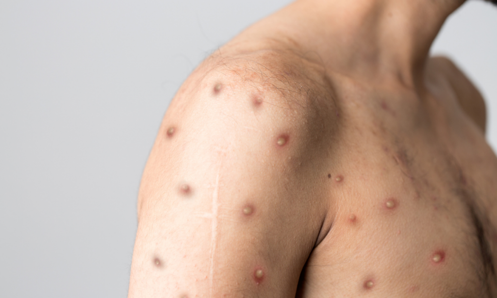 Anvisa decide liberar a aquisição de medicamentos e vacinas sem registro contra a Monkeypox
