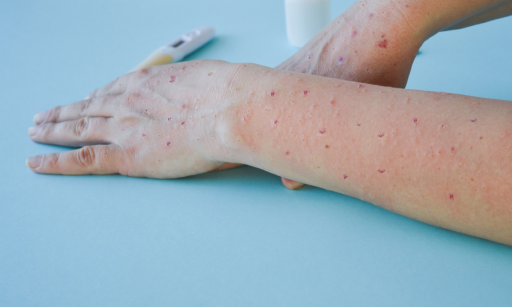 Mundo já registrou mais de 50 mil casos de Monkeypox desde o início do surto