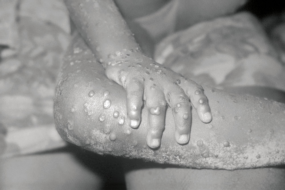 O avanço da monkeypox