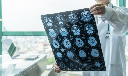 Droga experimental obtém avanço inédito contra Alzheimer