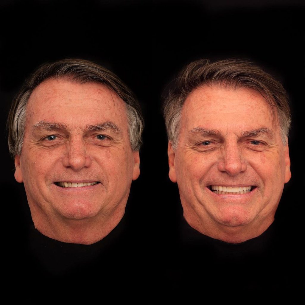 Cercado em investigações sobre joias, Bolsonaro faz ‘harmonização’ dental de quase R$ 100 mil