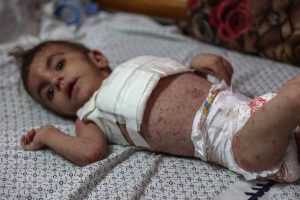 Sarna e piolho se propagam nas crianças em Gaza