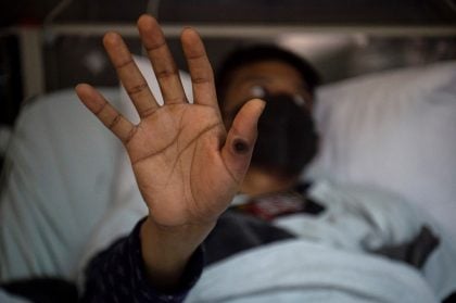 CFM orienta médicos para o monitoramento da mpox no Brasil