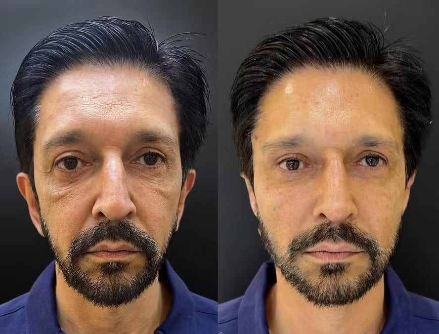 Nunes ataca jornalista após ser questionado sobre suposta vantagem indevida em harmonização facial