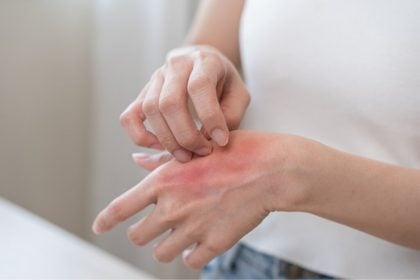 Veja os sintomas da queimadura causada pelo frio