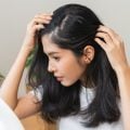 Veja as causas e os tratamentos para a alopecia areata