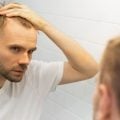 Transplante capilar: entenda quando pode ser necessário refazer o procedimento