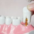 Dente do siso: por que algumas pessoas não têm?