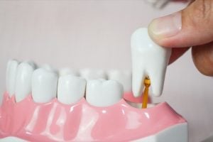 Dente do siso: por que algumas pessoas não têm?